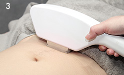 【光脱毛】全身セット（顔、VIO含む）