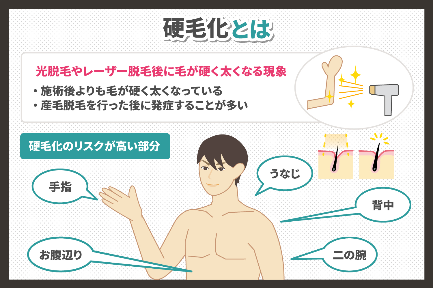 脱毛時の硬毛化とは 硬毛化の原因やならないための対策 硬毛化になりやすい部位について Zelmo Style Magazine