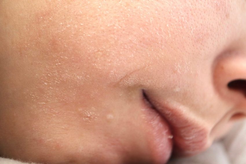 花粉による肌荒れの主な症状